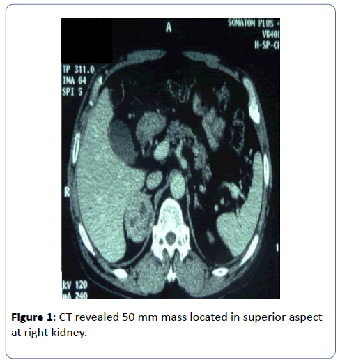 clinical-experimental-nephrology-CT-revealed-mass-located