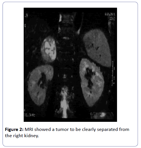 clinical-experimental-nephrology-MRI-showed-tumor